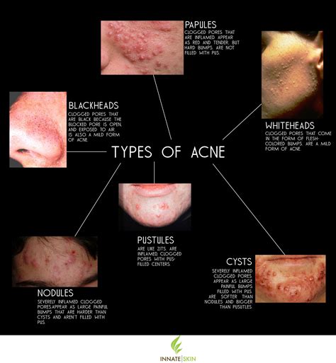 Pimple Treatment & Acne Treatment: Dr Harold Ma