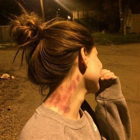 Hickey là gì? Cách thực hiện và xóa bỏ vết bầm do HickeyHickey là gì? Cách thực hiện và xóa bỏ ...