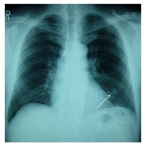 (a) Histology of the pulmonary hamartoma. The section showing the... | Download Scientific Diagram