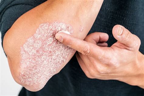 Your Health | Psoriasis is more than skin deep | The North West Star | Mt Isa, QLD