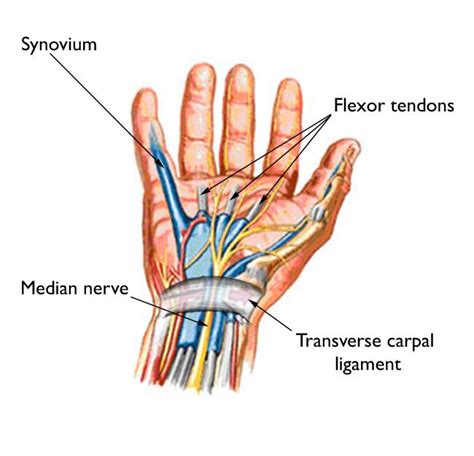 Carpal Tunnel Syndrome - Mendelson Kornblum