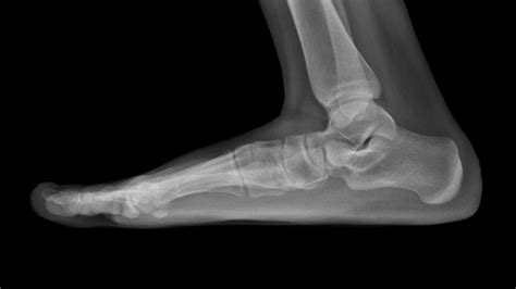 Tarsal Coalition: Causes, Symptoms, and Solutions - Sport Doctor London