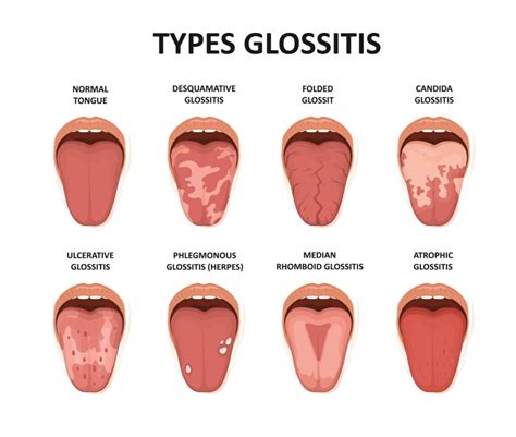 Bumps on the Back of Tongue - Causes, Symptoms & Treatments