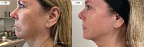 B + A: Juvederm Voluma - Cheeks, Chin and Jawline