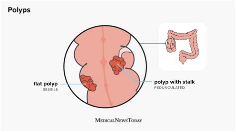 Sessile polyps: Causes, risk factors, and treatment