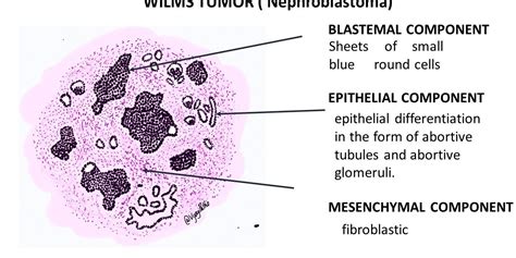 WILMS TUMOR( NEPHROBLASTOMA) | Pathology Made Simple