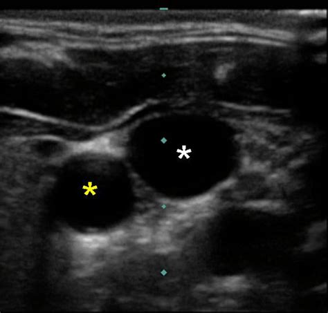 Carotid Arteries Ultrasound