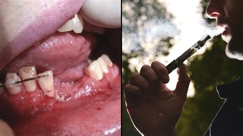 Vape Explodes In Teenager's Mouth Breaking Their Teeth