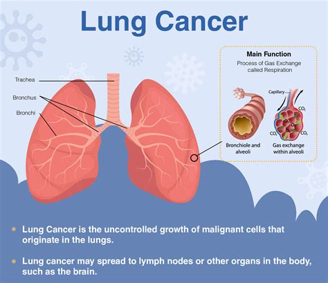 Overview of Lung Cancer: Signs, Symptoms, Diagnosis & Treatment