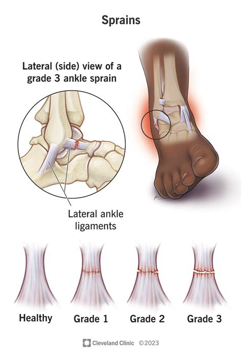 Ankle Sprain Grades 1