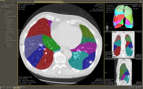 WTSA - Pre-Operative Three Dimensional (3-D) Lung Segmental ...