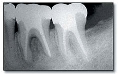 Periapical X Ray