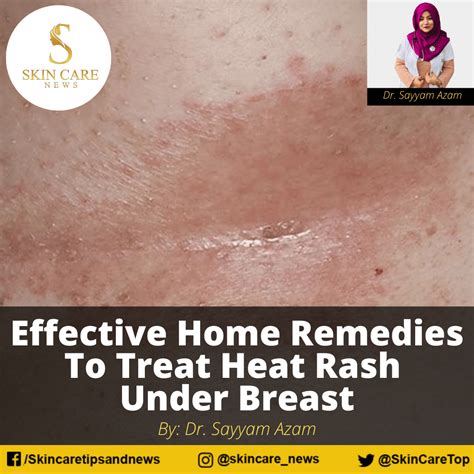 Effective Home Remedies To Treat Heat Rash Under Breast