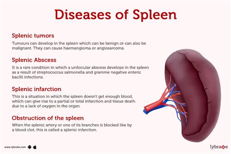 Enlarged Spleen (Splenomegaly): Symptoms, Causes Treatment, 55% OFF