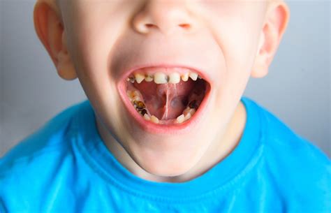 Kids’ teeth – from six months to six years | Health24