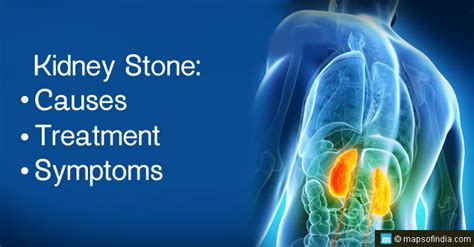 Kidney Stone: Causes, Symptoms and Treatment - India