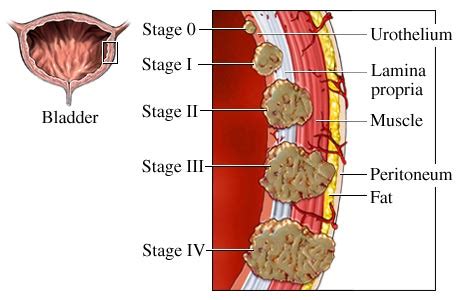 Bladder Cancer Stages