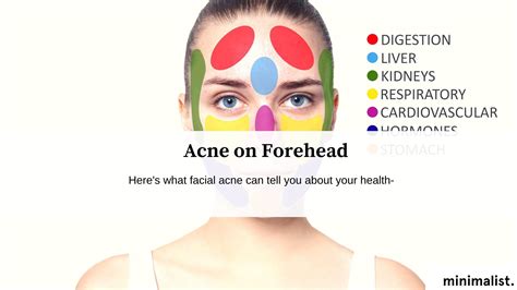 Forehead Acne: Causes and Treatment – Minimalist