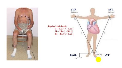 Part 3: Chest leads(Precordial Leads) from V1 to V6 - YouTube