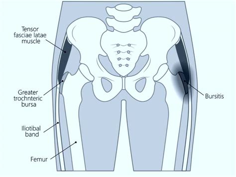 Hip Bursitis Anatomy