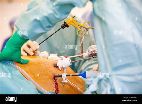 Liver surgery hi-res stock photography and images - Alamy