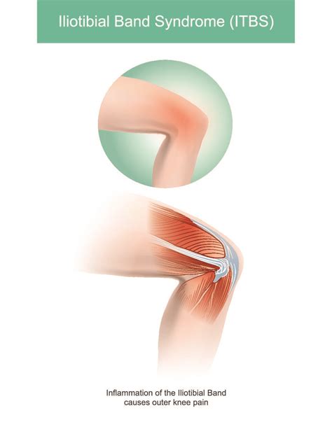 Demystifying the IT Band Syndrome | Moveo Sports and Manual Physiotherapy