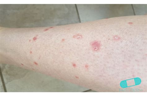 Itchy Red Bumps & Common Causes - First Derm Blog