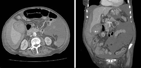 A. CT-scan image in which a hemoperitoneum and a gallbladder full of... | Download Scientific ...