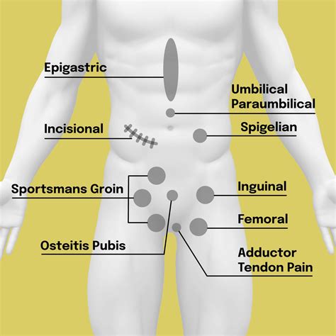 Hernia Types - The Hernia Clinic