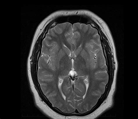 mri-brain-arachnoid-cyst-0001-800 - MRI at Melbourne Radiology Clinic