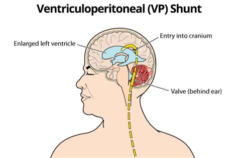 Walter's Hydrocephalus Education blog: Recovery after VP shunt implant ...