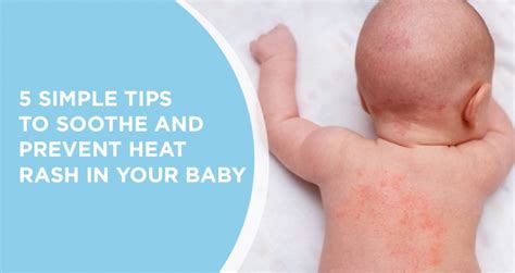 Mild Heat Rash On Babies