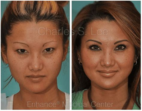 Asian Eyelid Surgery Can Give You the Look You Want | Charles S. Lee, MD