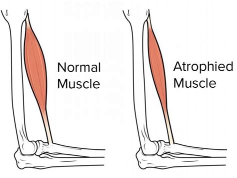 Muscle Atrophy: Causes, Symptoms & More | Total Orthocare