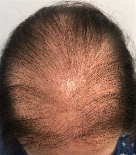 Alopecia Androgénica Femenina Premenopausica - Mujeres, Pérdida de pelo, cabello, caida ...