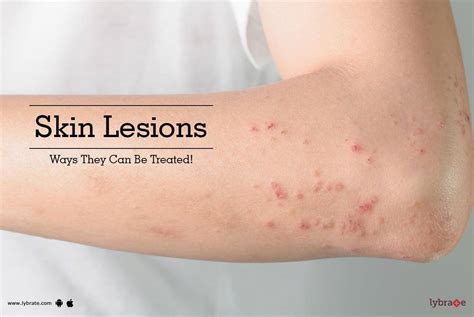 Skin Lesions - Ways They Can Be Treated! - By Dr. Amit Beniwal | Lybrate