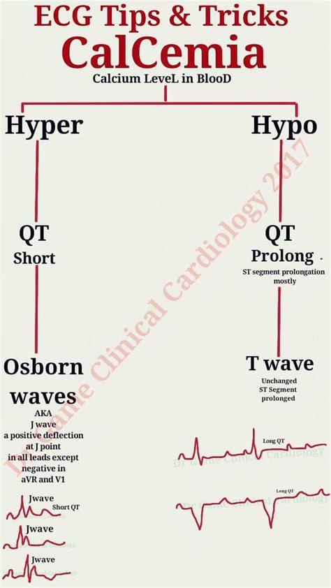 Hypocalcemia Ekg