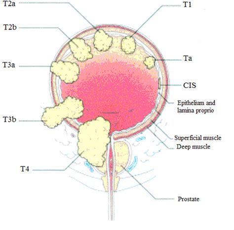 Stages of bladder cancer from Meyer et al., (2002). Bladder cancer can... | Download Scientific ...