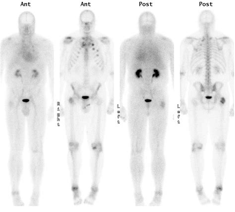 Nuclear Medicine & PET: Bone Scan