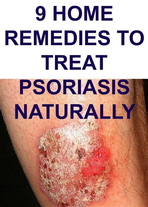 Plaque Psoriasis Scalp Home Remedy - Homemade Ftempo