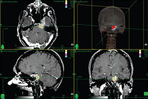 Cavernous sinus/petroclival meningioma – immediate postoperative radiosurgery for residual ...