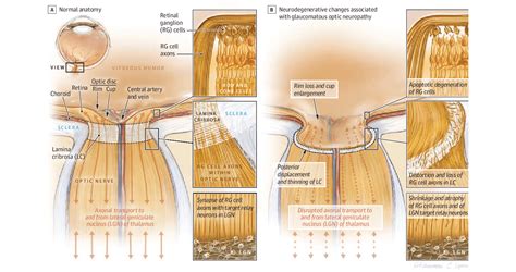 How Does Optic Nerve (Ganglion Cell) Damage Occur? | Glaucoma Australia