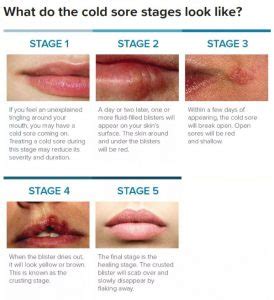 Cold Sore Stages (with Pictures) - The 5 Stages of Cold Sore Outbreak