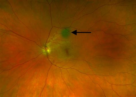 Choroidal Nevus