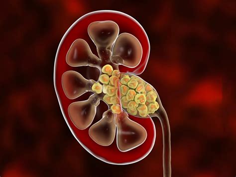 High Calcium and Potassium Diet may Help Prevent Development of Kidney ...