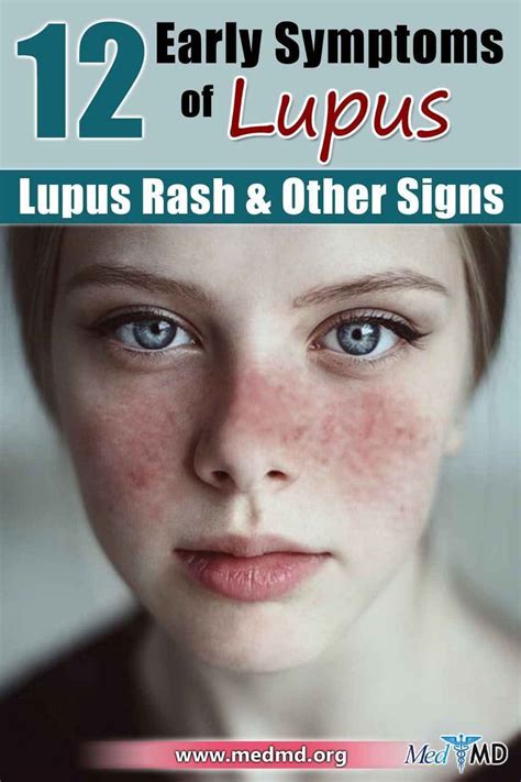 Lupus Symptoms Face Rash Remedies, Subacute Cutaneous Lupus, Systemic ...