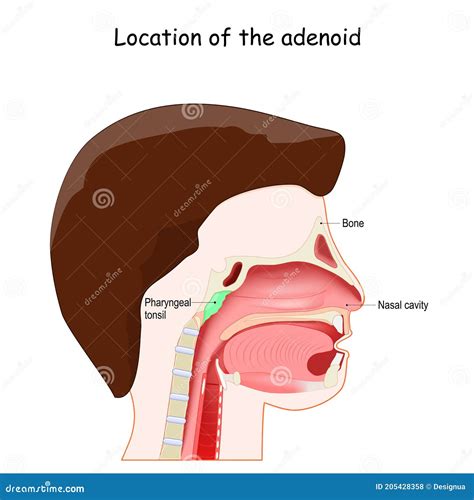 Enlarged Adenoid Glands Cartoon Vector | CartoonDealer.com #46045793