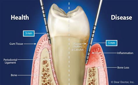 Understanding Periodontal Pockets