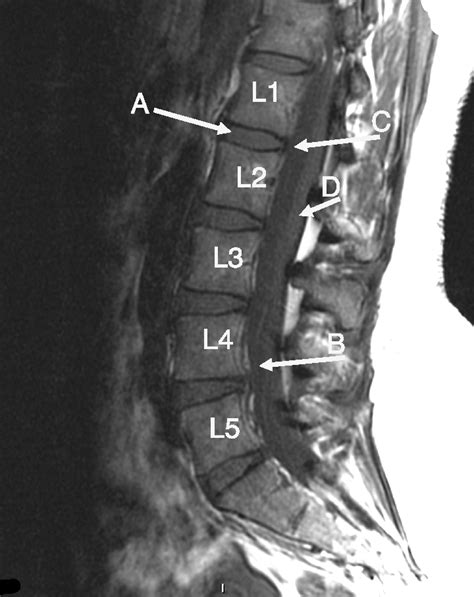 Mri Lumbo Sacral Spine Sagittal View Showing Reduced Height Of L L | Hot Sex Picture