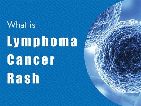 What is Lymphoma Cancer Rash? - Massive Bio